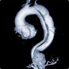 Angiografia aorty brzusznej