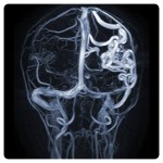 МРТ исследование венозного оттока