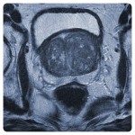 МРТ предстательной железы по PI-RADS v2