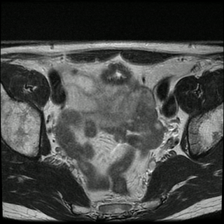 obraz przedstawiający badanie rezonansem prostaty