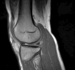 obraz przedstawiający badanie rezonansem stawu kolanowego 