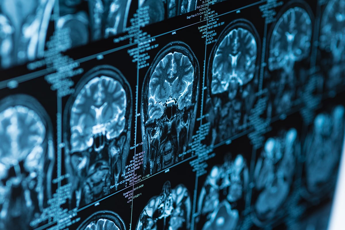 Specjalistyczne badania MRI mózgu dostępne w Iławie